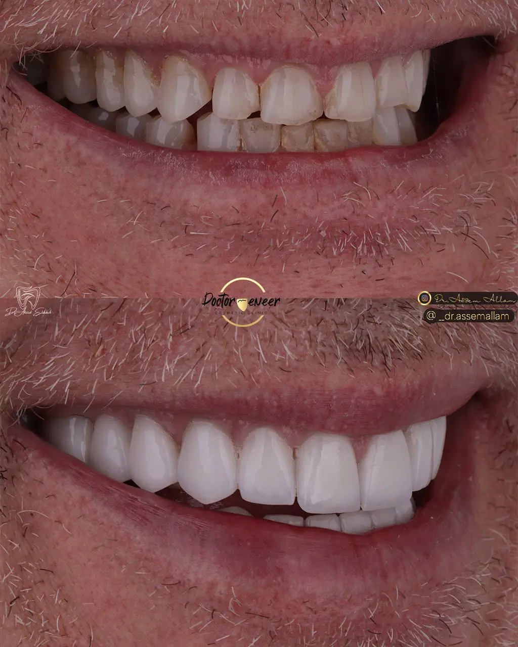 Jed Lateral Smile Before and After